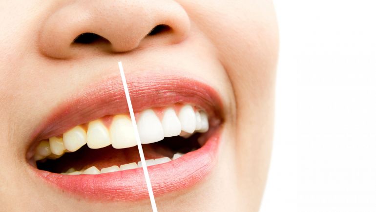 Descubre el revolucionario tratamiento de blanqueamiento dental láser en Clínica Dental Odens