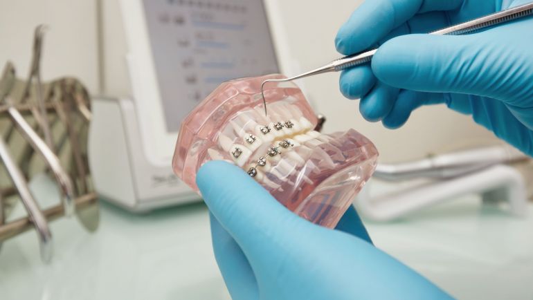 Implantes dentales: La mejor opción para una sonrisa duradera y funcional